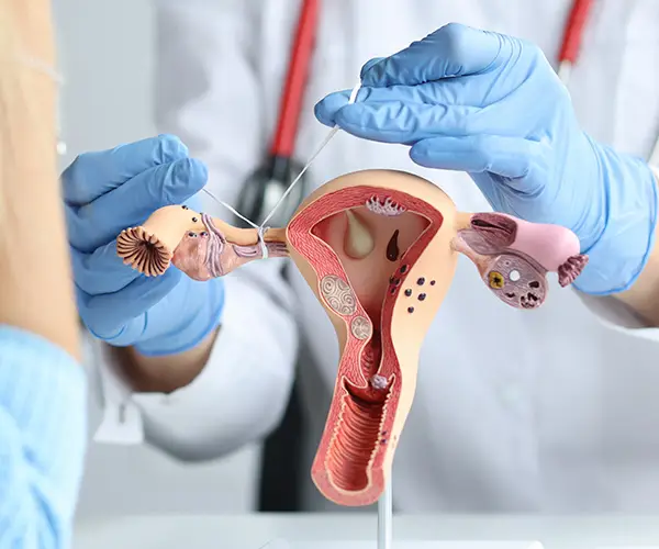 mioma uterino