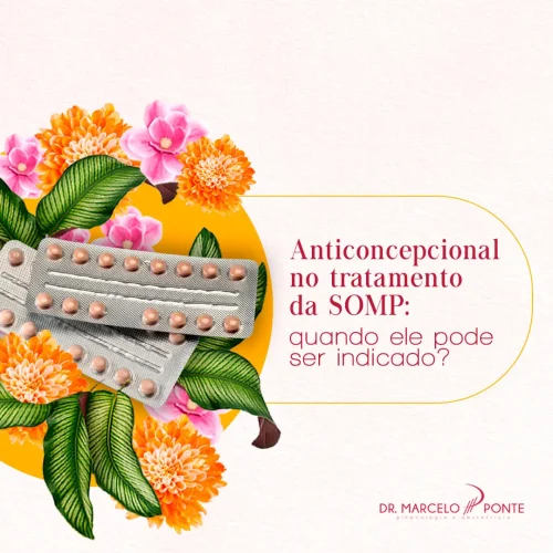 Anticoncepcional no tratamento da SOMP quando ele pode ser indicado?