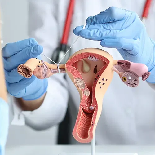 mioma uterino