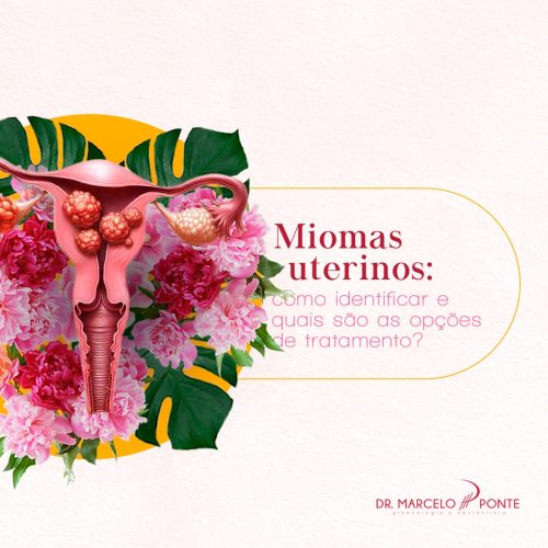 Miomas Uterinos: Como Identificar e Quais São as Opções de Tratamento?
