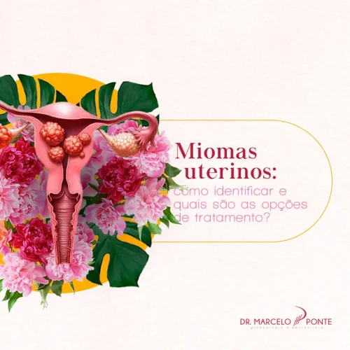 Miomas Uterinos: Como Identificar e Quais São as Opções de Tratamento?
