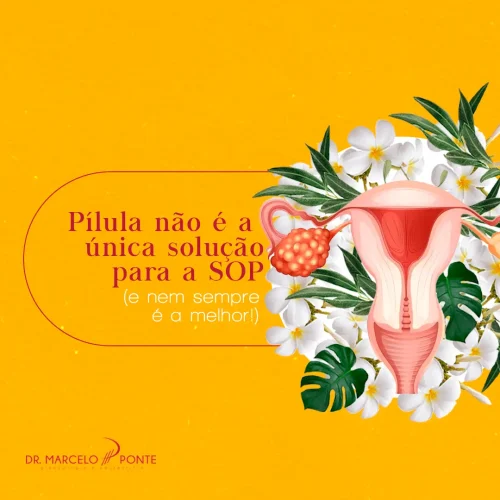 Pílula não é a única solução para a SOP! - e nem sempre é a melhor